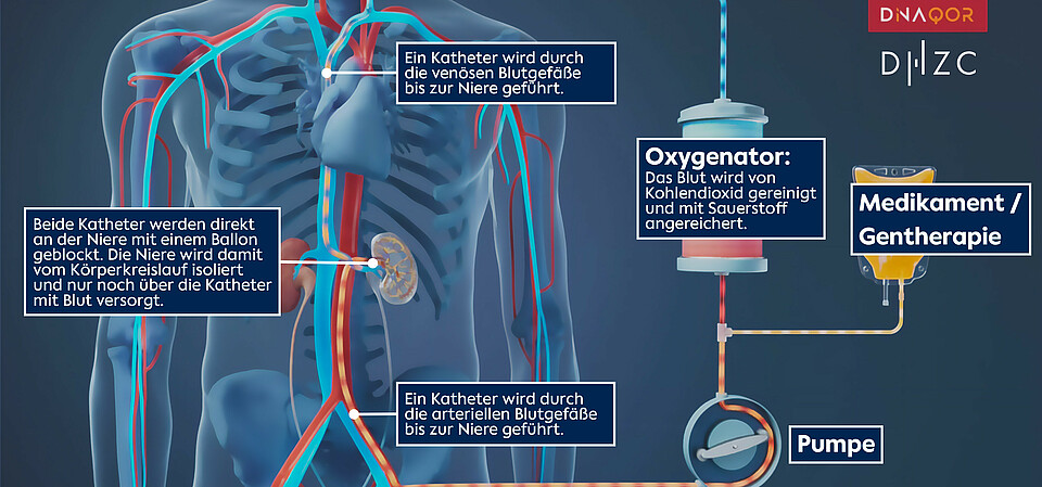 Illustration of the catheter-based “closed-loop perfusion system” Illustration of the catheter-based “closed-loop perfusion system”